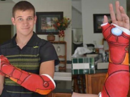 Chcete vedieť, ako si spríjemniť pohľad na vašu zlomeninu? :D